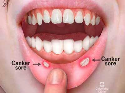 Herpes and canker sore signs: similarities and differences