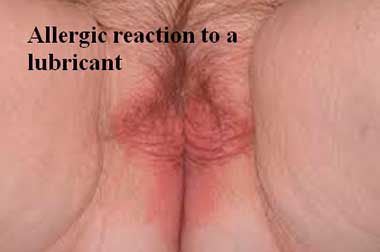 Allergic reaction to a lubricant