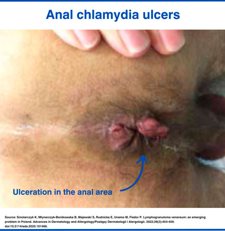 Anal chlamydia ulcers