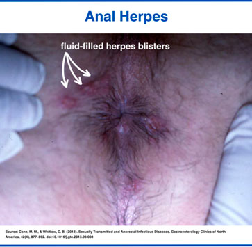 Anal herpes