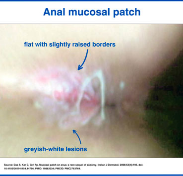 Anal mucosal patch