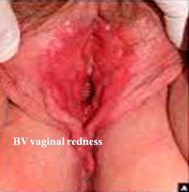 BV vaginal redness