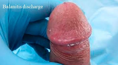 Balanitis discharge