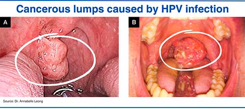 Cancerous lumps caused by HPV infection
