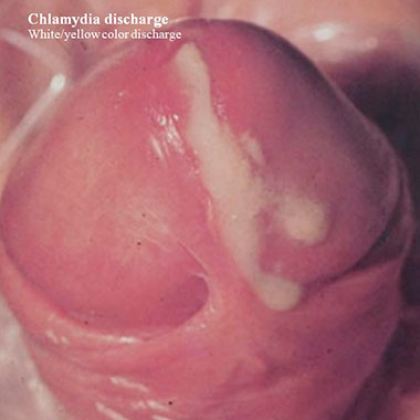 Chlamydia discharge. White/yellow color discharge.