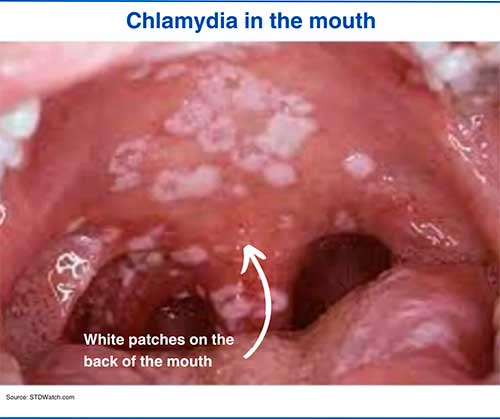 Chlamydia in the mouth