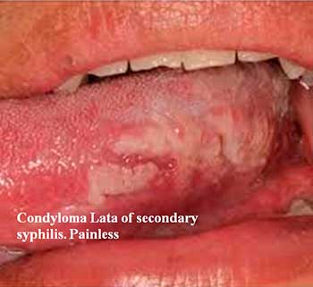 Condyloma Lata of secondary syphilis. Painless