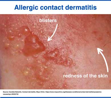 Contact dermatitis rash photo