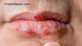 Crusted herpes sores