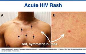 Early HIV rash: small, red, slightly flat or raisedbumps on the chest.
