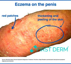 Eczema on penis