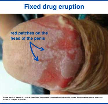 Fixed drug eruption rash on the penis