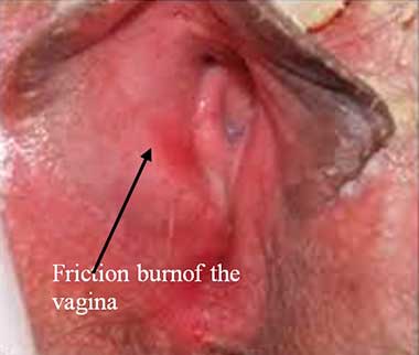 Friction burnof the vagina