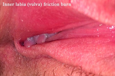 Inner labia (vulva) friction burn Inner labia (vulva) friction burn