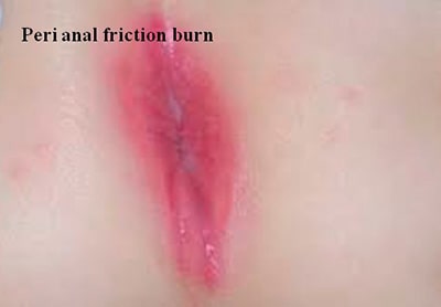 Peri anal friction burn Peri anal friction burn