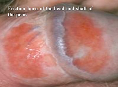 Friction burn of the head and shaft of the penis Friction burn of the head and shaft of the penis