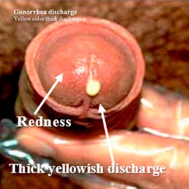 Gonorrhea discharge. Yellow color thick discharge.