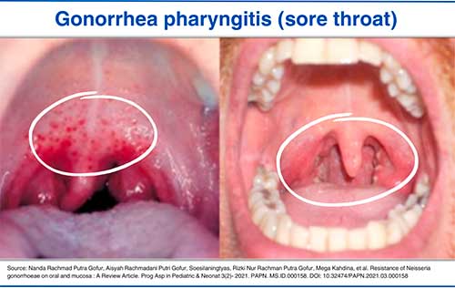 Gonorrhea pharyngitis (sore throat)