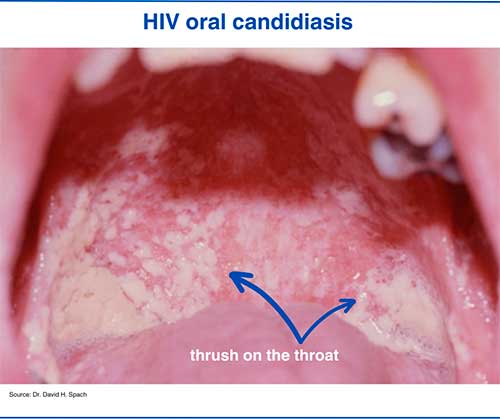 HIV oral candidiasis
