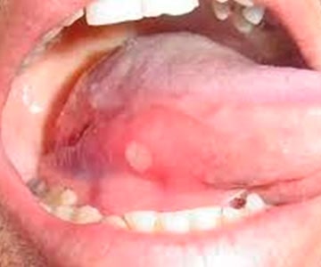 Early or “acute” HIV mouth sores pictures.