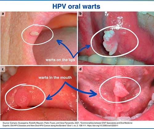 HPV oral warts