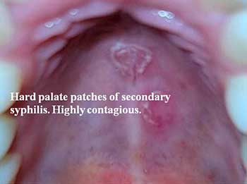 Hard palate patches of secondary syphilis. Highly contagious.