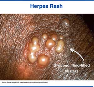 Herpes rash on the penis