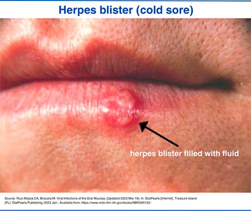 Herpes blister (cold sore)