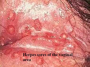 Herpes sores of the vaginal area