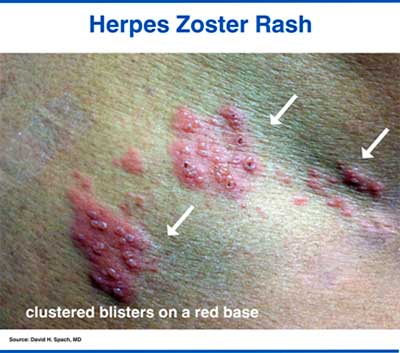 Herpes zoster rash in a patient with HIV appears as grouped fluid-filled blisters on a red base.