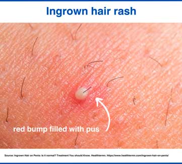 Ingrown hair rash
