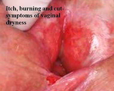 Itch, burning and cut- symptoms of vaginal dryness