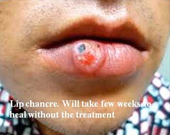 Lip chancre. Will take few weeks to heal without the treatment