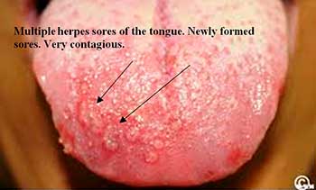 Multiple herpes sores of the tongue. Newly formed sores. Very contagious.