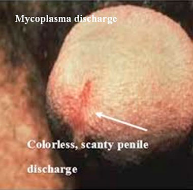 Mycoplasma discharge