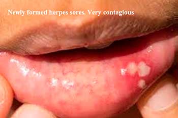 Newly formed herpes sores. Very contagious