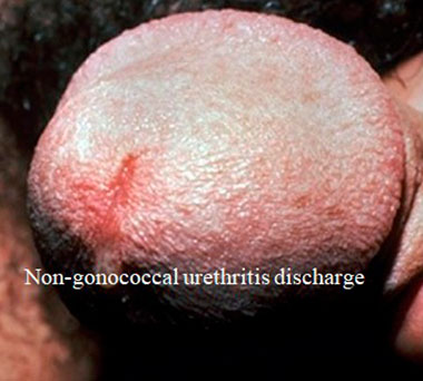 Non-gonococcal urethritis discharge