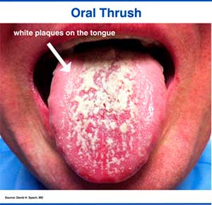 Oral thrush in an HIV patient that appears as white plaques on the tongue.