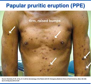 Papular pruritic eruption (PPE) in HIV patient presented with multiple, itchy, raised bumps on the chest and upper limbs.