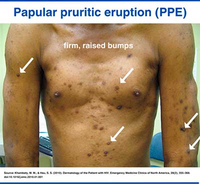 Papular pruritic eruption (PPE) in HIV patient presented with multiple, itchy, raised bumps on the chest and upper limbs.