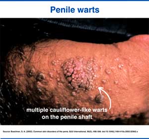 Penile warts photo