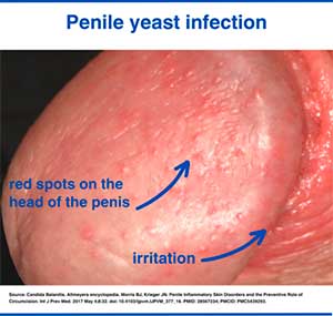 Penile yeast infection photo