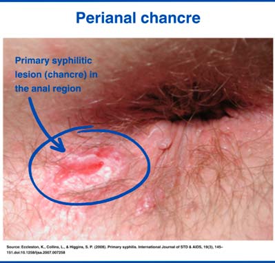 Perianal chancre