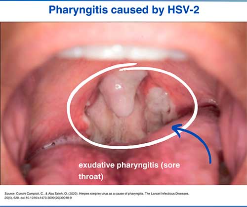 Pharyngitis causes by HSV-2