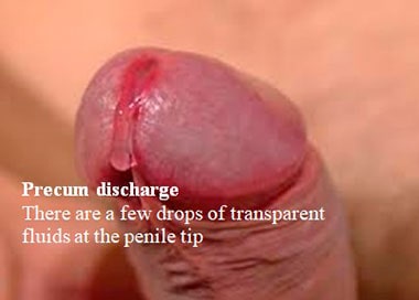 Precum discharge. There are a few drops of transparent fluids at the penile tip.