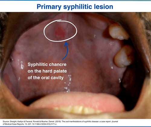 Primary syphilis lesion
