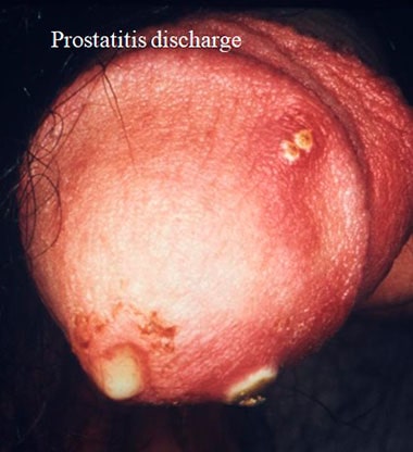 Prostatitis discharge