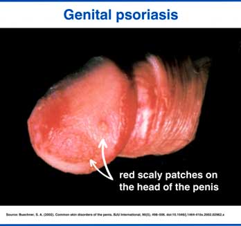 Psoriasis rash on the penis