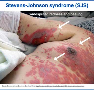 SJS-resulted peeling blisters and redness, resembling severe skin burn.