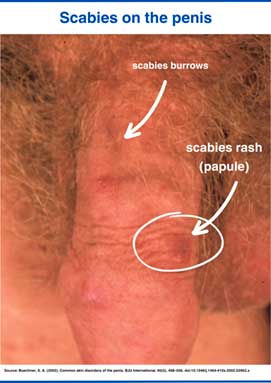 Scabies on the penis